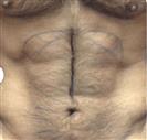 Six Pack - Estethica Surgical Medical Center