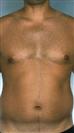 Six Pack - Estethica Surgical Medical Center