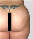 Brazilian Butt Lift - Estethica Surgical Medical Center