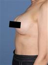 Breast Augmentation - Estethica Surgical Medical Center