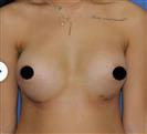 Breast Augmentation - Estethica Surgical Medical Center
