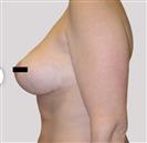 Breast Lift - Estethica Surgical Medical Center