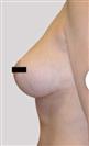 Breast Reduction - Estethica Surgical Medical Center