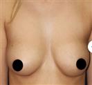 Breast Reduction - Estethica Surgical Medical Center