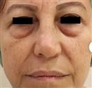 Eyelid Aesthetics (Blepharoplasty) - Estethica Surgical Medical Center