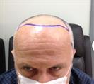 Hair Transplant - Estethica Surgical Medical Center