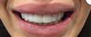 Teeth Whitening - Estethica Surgical Medical Center
