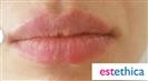Lip Enhancement (Lip Augmentation) - Estethica Surgical Medical Center
