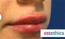 Lip Enhancement (Lip Augmentation) - Estethica Surgical Medical Center