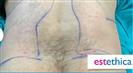Liposuction (Abdominal) - Estethica Surgical Medical Center