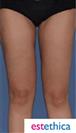 Thigh Lift - Estethica Surgical Medical Center