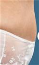 Tummy Tuck (Abdominoplasty) - Estethica Surgical Medical Center