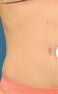 Tummy Tuck (Abdominoplasty) - Estethica Surgical Medical Center