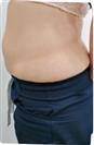Abdominoplasty (Tummy Tuck) - Estethica Surgical Medical Center