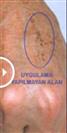 Cynosure Icon (Palomar) - Turkeyana Clinic