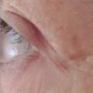 D.A.S. Medical - Periorbital Wrinkles - Turkeyana Clinic