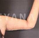 Arm Lift - Turkeyana Clinic