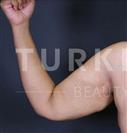 Arm Lift - Turkeyana Clinic