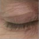 D.A.S. Medical - Eyelid Plasty (Blepharoplasty) - Turkeyana Clinic