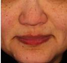 Baby Face Application - Turkeyana Clinic
