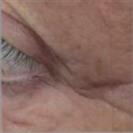 D.A.S. Medical - Periorbital Wrinkles - Turkeyana Clinic