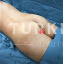 Brazilian Butt Lift - Turkeyana Clinic