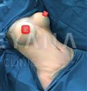 Abdominal Liposuction - Breast Augmentation - Turkeyana Clinic