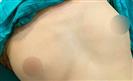 Breast Augmentation - Turkeyana Clinic