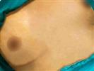 Breast Augmentation - Turkeyana Clinic