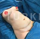 Abdominal Liposuction - Breast Augmentation - Turkeyana Clinic