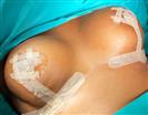 Breast Lift - Turkeyana Clinic