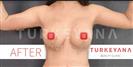 Breast Lift - Abdominal Etching - Turkeyana Clinic