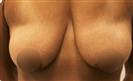 Breast Lift - Turkeyana Clinic