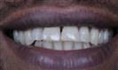 Dental Crown - Turkeyana Clinic