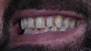 Dental Crown - Turkeyana Clinic