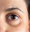 Eyelid Surgery - Turkeyana Clinic