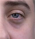 Lower Eyelid Surgery (Blepharoplasty) - Turkeyana Clinic