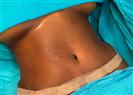 Abdominal Liposuction - Turkeyana Clinic