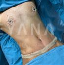 Gynecomastia Surgery - Abdominal Liposuction - Turkeyana Clinic