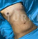 Gynecomastia Surgery - Abdominal Liposuction - Turkeyana Clinic