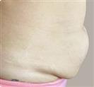 Abdominal Liposuction - Turkeyana Clinic