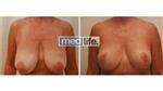 Breast Uplift - Medlife Group
