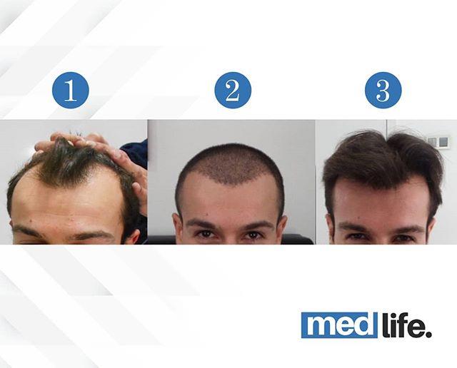 Hair Transplant - Medlife Group