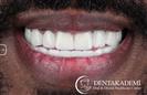 Tooth Extractions, Dental Implants, Root Canal Treatment, Smile Design with Crowns - DENTAKADEMI Oral and Dental Healthcare Center