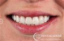 Root Canal Treatment, Smile Design with E-max Crowns - DENTAKADEMI Oral and Dental Healthcare Center