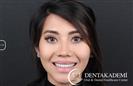 Laminate Veneer - DENTAKADEMI Oral and Dental Healthcare Center
