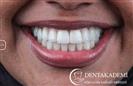 Root Canal Treatment, Laminate Veneers - DENTAKADEMI Oral and Dental Healthcare Center