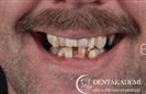 Tooth Extractions, Crown Length Extensions, Root Canal Treatment, Crowns: E-max and Zirconium Crowns - DENTAKADEMI Oral and Dental Healthcare Center