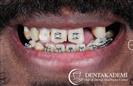 Tooth Extractions, Dental Implants, Root Canal Treatment, Smile Design with Crowns - DENTAKADEMI Oral and Dental Healthcare Center