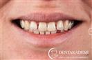 Root Canal Treatment, Smile Design with E-max Crowns - DENTAKADEMI Oral and Dental Healthcare Center
